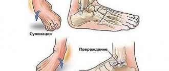 Ankle injuries