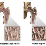 При остеопорозе структура костей сильно ослаблена