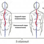 При S-образном сколиозе поражается одновременно грудной и поясничный отдел позвоночника