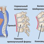 With Scheuermann-Mau, rounding of the spine occurs in the thoracic region near the spine