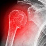 Причины и лечение перелома головки плечевой кости