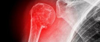 Причины и лечение перелома головки плечевой кости