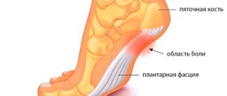 heel spur symptoms and treatment medications
