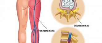 Radiculopathy develops as a result of pinched nerve root in the lumbar spine