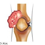 knee cancer