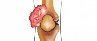 knee cancer