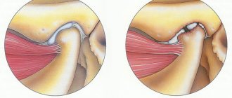 Разрушение височно-челюстного сустава