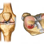 разрыв мениска колена