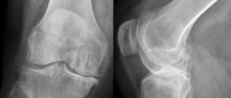 рентген коленного сустава