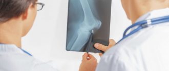 X-rays allow you to accurately determine the degree of arthrosis
