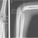 X-rays of the elbow joint (6 years). The nucleus of the medial epicondyle appears. 
