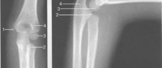 Рентгенограммы локтевого сустава (6 лет). Появляется ядро медиального надмыщелка.