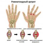 Ревматоидный артрит пальцев рук: первые симптомы