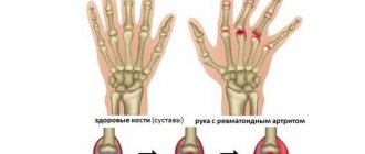 Rheumatoid arthritis of the fingers: first symptoms