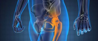 Sarcoma of the hip