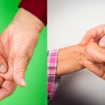 Symptoms of hand arthritis