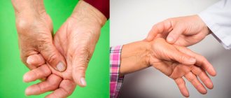 Симптомы артрита рук