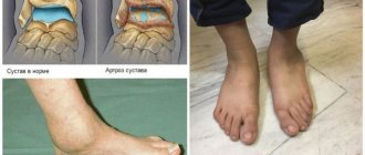 Symptoms of ankle arthrosis appear gradually