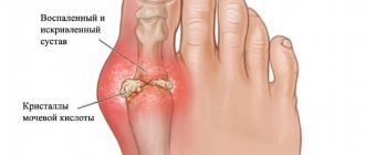 Symptoms and treatment of arthrosis of the toes