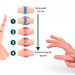 Symptoms of rheumatoid arthritis