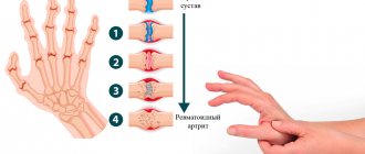Симптомы ревматоидного артрита