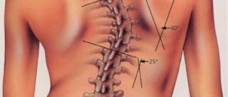 Scoliosis: what is it