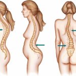 Scoliosis may be accompanied by complications such as kyphosis and lordosis
