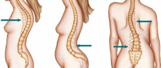 Scoliosis may be accompanied by complications such as kyphosis and lordosis