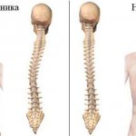 Scoliosis of the spine
