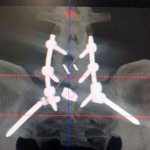 Spinal fusion - after x-ray after surgery