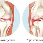 Сравнение нормального сустава и пораженного артритом