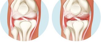 Сравнение нормального сустава и пораженного артритом