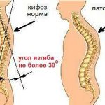 The degree of kyphosis is determined based on measurements of the angle of curvature