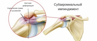 subacromial pain syndrome