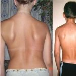 Shoulder blades stick out in a child with scoliosis