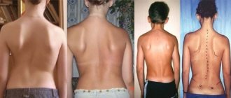 Shoulder blades stick out in a child with scoliosis