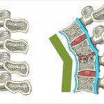Tuberculous spondylitis provokes deformation and destruction of the vertebrae