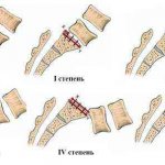 exercises for displacement of the lumbar vertebrae