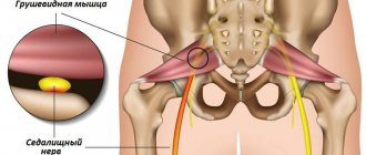 What is the essence of piriformis syndrome?