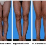 valgus, varus and normal knees