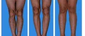 вальгусные, варусные и нормальные колени