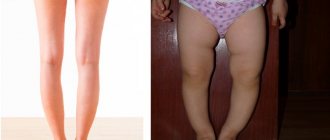 Varus deformity of the leg in children and adults