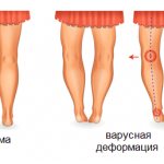 Varus deformity in children