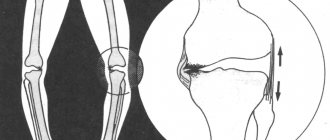 Varus (O-shaped) Leg Deformity (Blount&#39;s Disease)