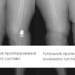 Виды эндопротезирования коленного сустава