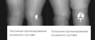 Types of knee replacement