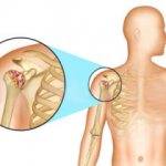 Inflammation of the shoulder joint
