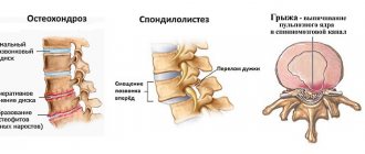Заболевания позвоночника, при которых чаще всего появляется боль в спине