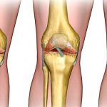 Replacement, endoprosthetics of the knee joint, price in St. Petersburg