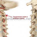 Pinched nerve in the cervical spine